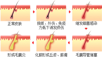 毛囊炎