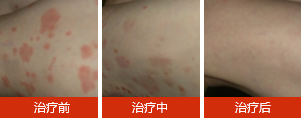 牛皮癣