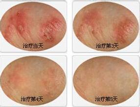 疥疮
