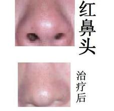 酒糟鼻