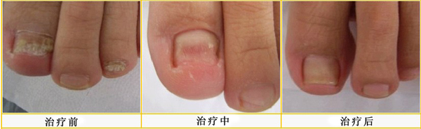灰指甲治疗